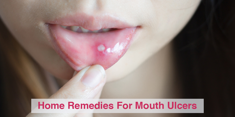 10 Home remedies to soothe canker sore
